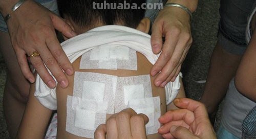 小孩能用三伏灸吗?