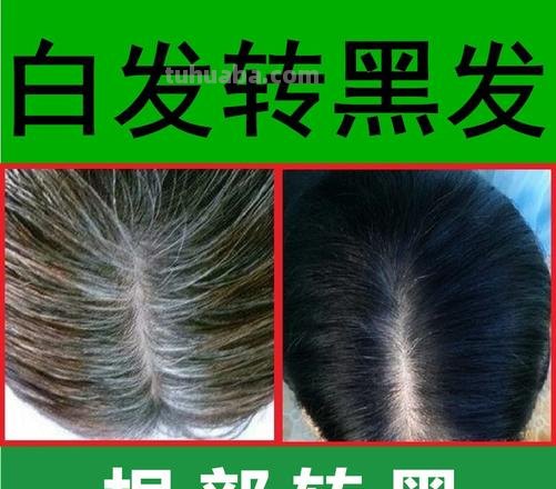 白发 白发怎样治疗才真正转黑